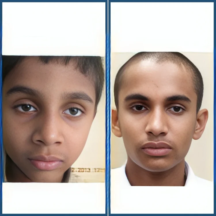 Cataract-2